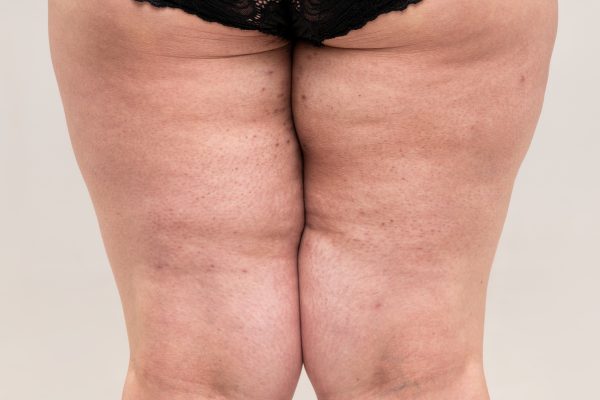 Back view of a woman’s legs with visible signs of lipedema, showing disproportionate fat distribution and texture changes in the thighs and calves.