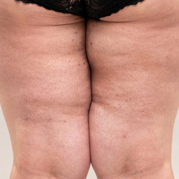 Back view of a woman’s legs with visible signs of lipedema, showing disproportionate fat distribution and texture changes in the thighs and calves.