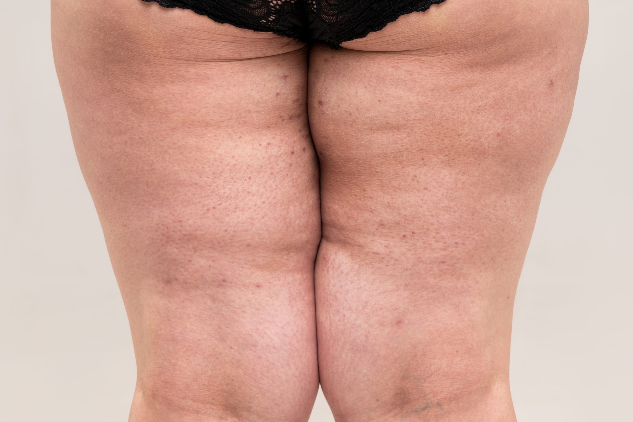 Back view of a woman’s legs with visible signs of lipedema, showing disproportionate fat distribution and texture changes in the thighs and calves.