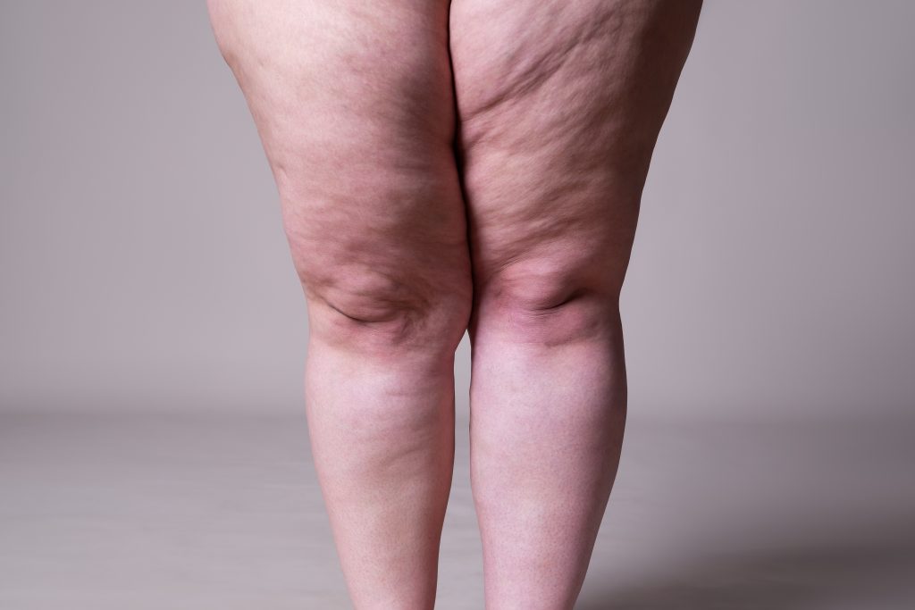 Front view of legs with lipedema showing disproportionate fat distribution, swelling, and skin texture changes in the thighs and knees